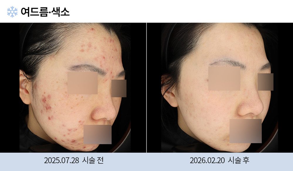 여드름 색소