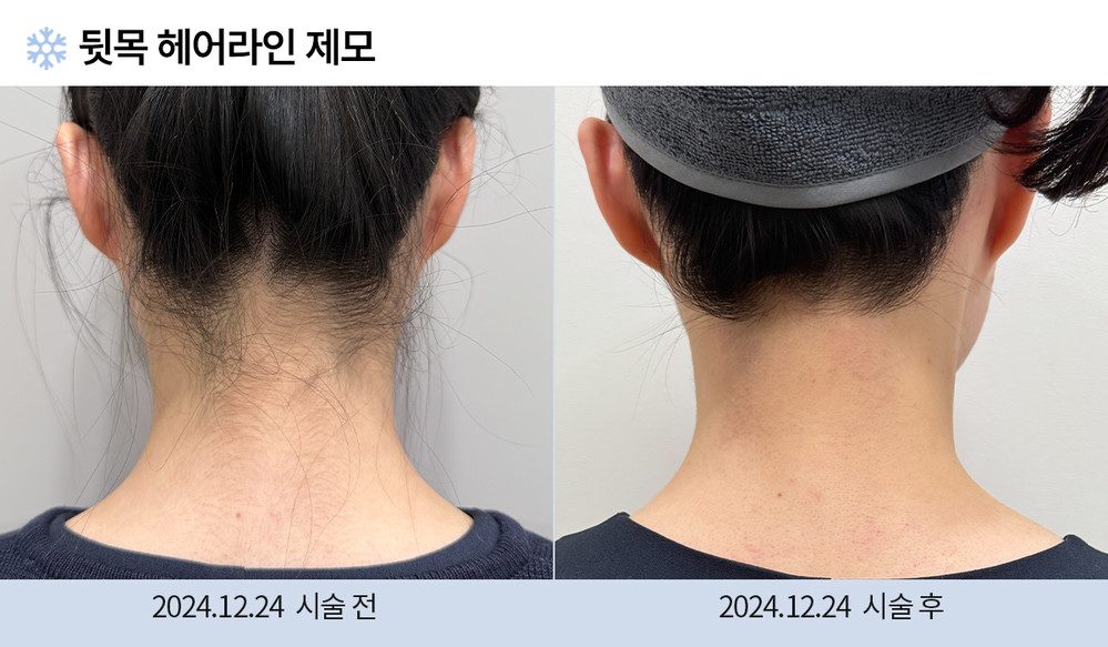 뒷목 헤어라인 제모